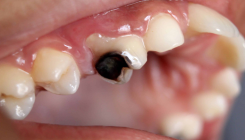 Night Snacks and Tooth Decay How Late Eating Changes Cavity Risk