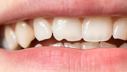 Tiny Chips on Front Teeth When to Repair and When to Just Smooth Them
