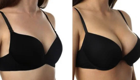 Best Breast Agumentation Clinic In Bangalore